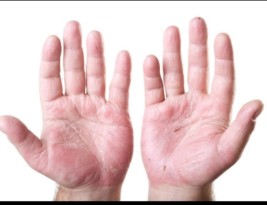 نکاتی در مورد خشکی پوست پس از شستشوی دست _دکتر امید زرگری متخصص پوست